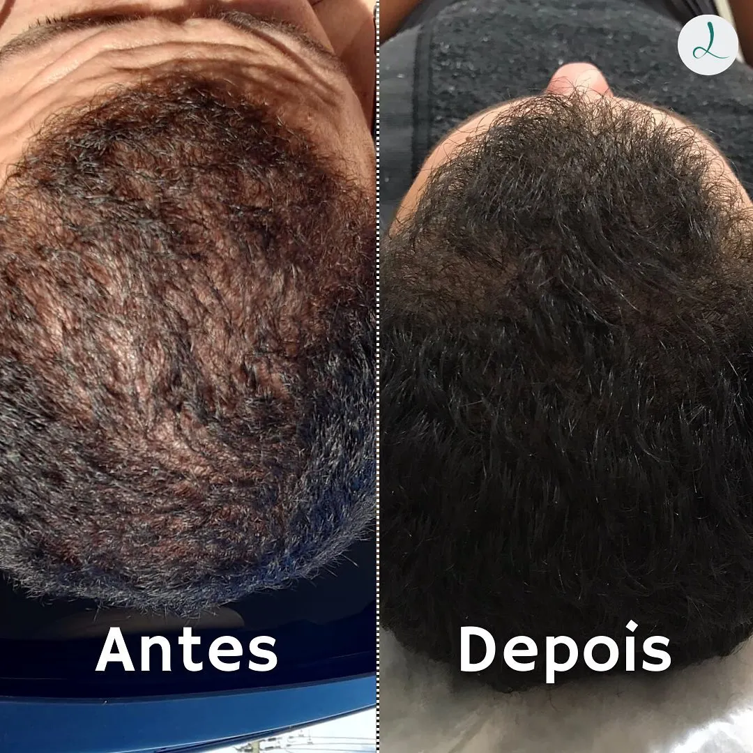 Antes e depois de terapia capilar no topo da cabeça
