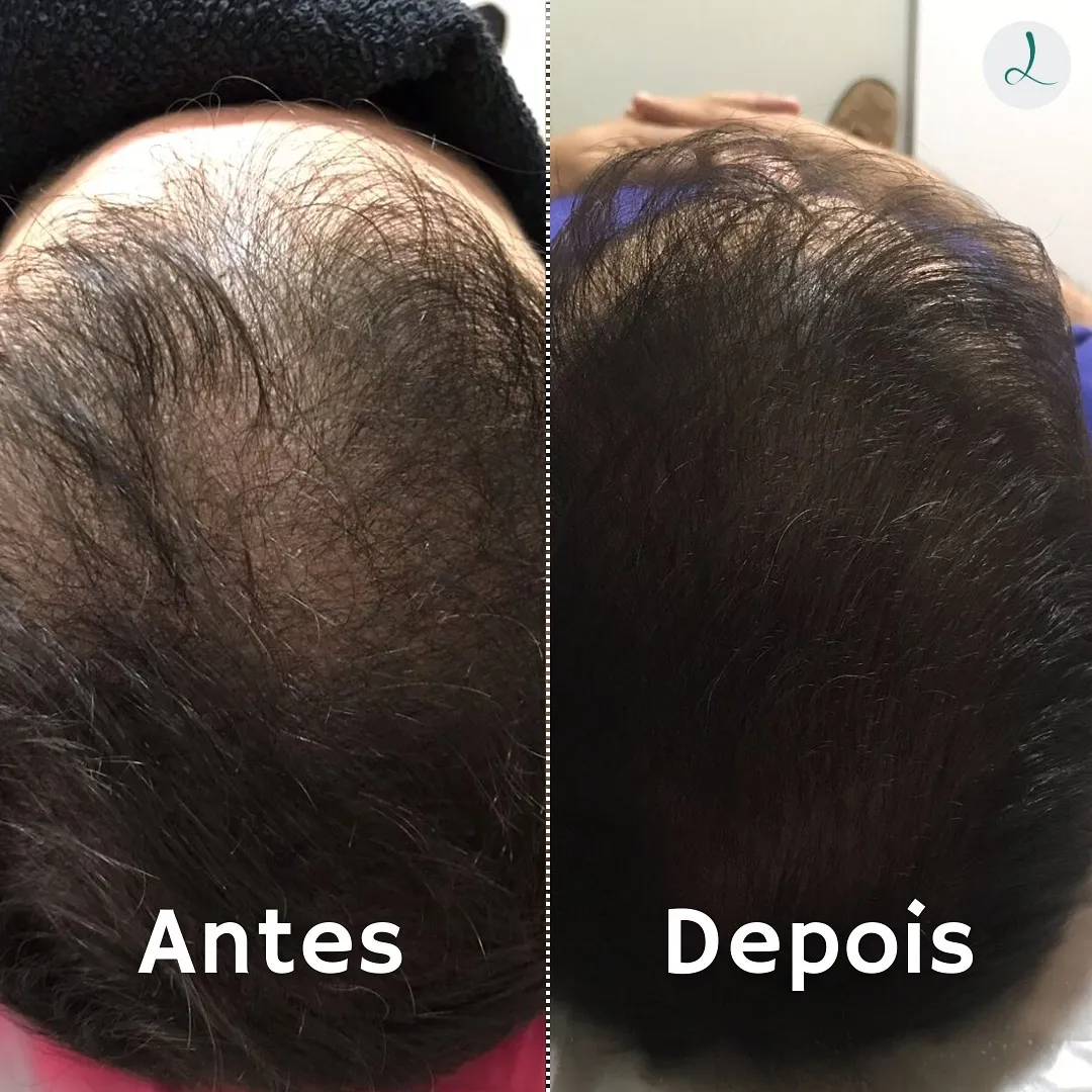 Antes e depois: aumento da densidade capilar