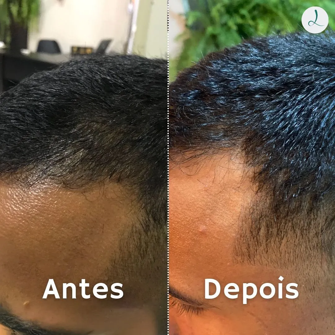 Antes e depois de terapia capilar masculina nas entradas